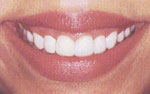 Proper Teeth