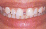 gap between the teeth